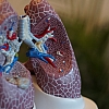 Explore Treatment Options & Ways to Prevent Lung Cancer